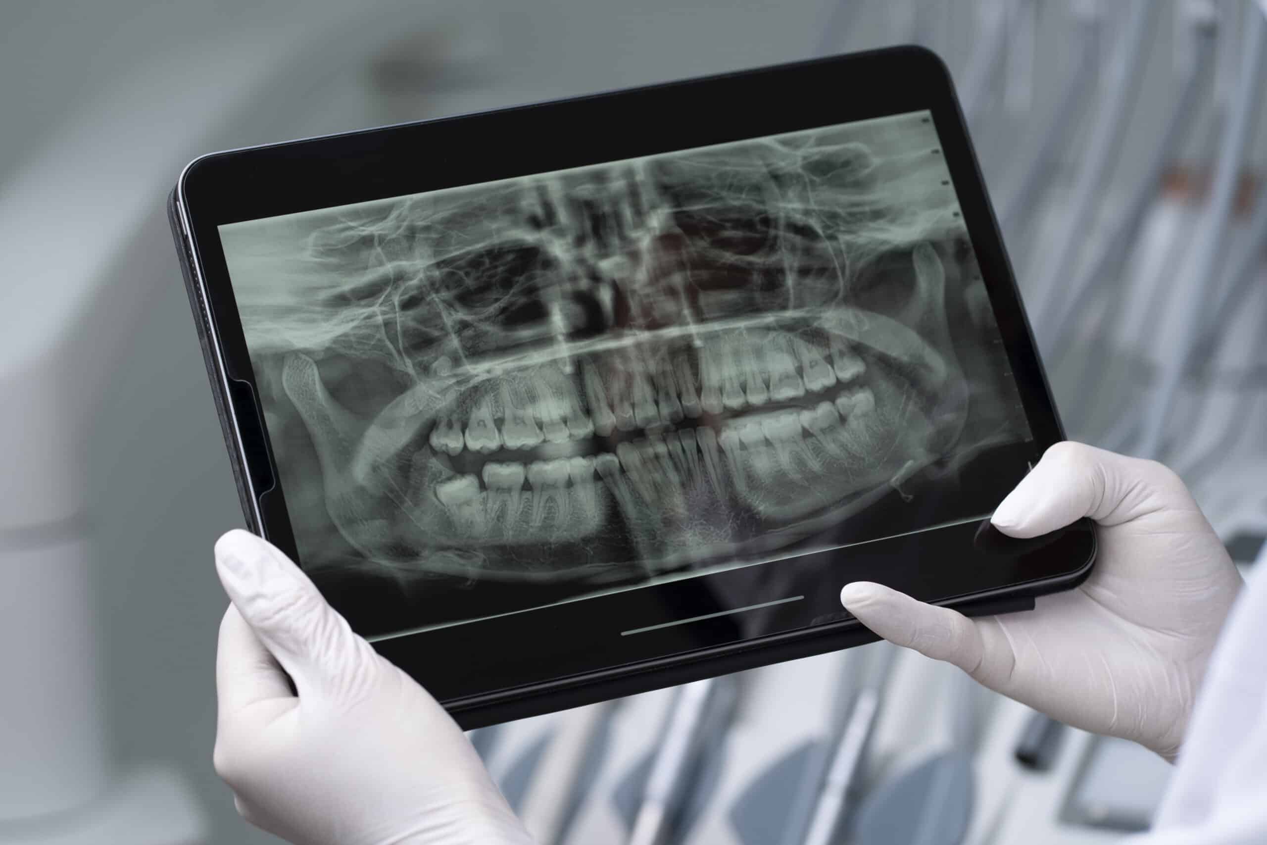 Dental X-Rays in Laguna Hills
