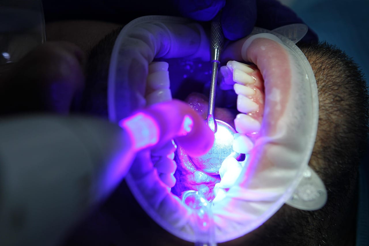 Teeth Whitening Options in Laguna Hills – Which Works Best?